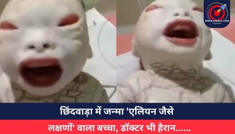 छिंदवाड़ा में जन्मा ‘एलियन जैसे लक्षणों’ वाला बच्चा, डॉक्टर भी हैरान……