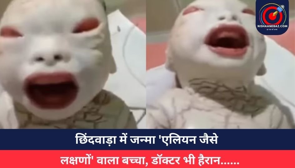 छिंदवाड़ा में जन्मा ‘एलियन जैसे लक्षणों’ वाला बच्चा, डॉक्टर भी हैरान……