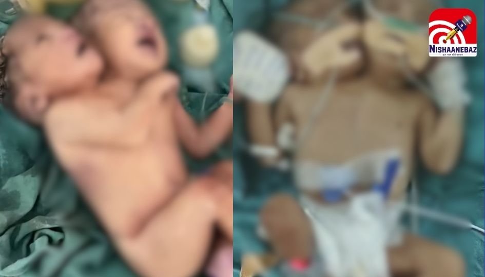 Dewas News : दो सिर वाली बच्ची ने तोड़ा दम…..