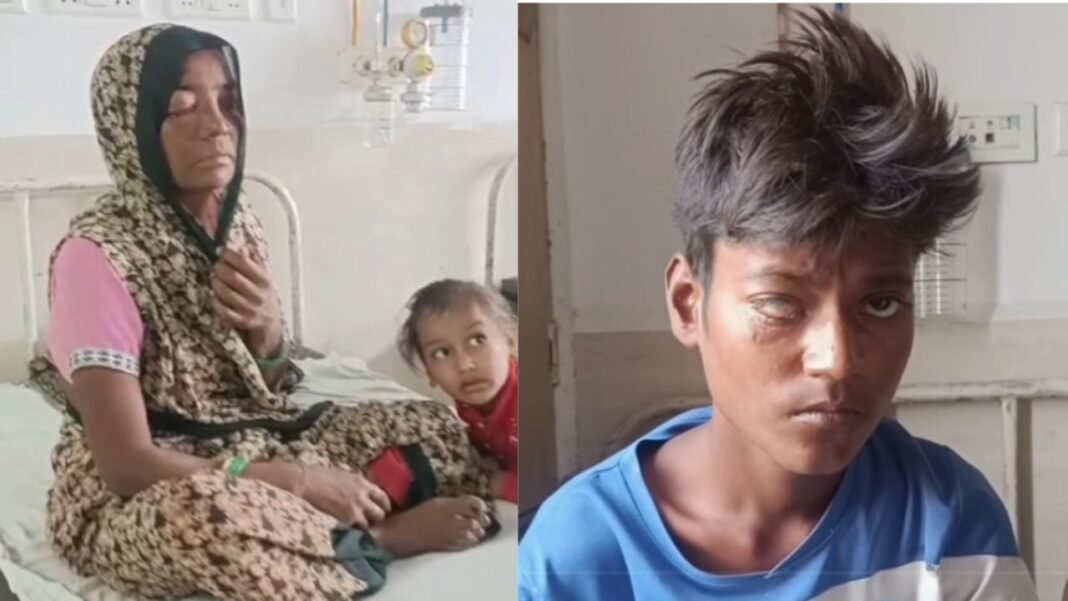 Health crisis : दीपावली पर सस्ती ‘कैल्शियम कार्बाइड गन’ का कहर, ग्वालियर में 17 लोग अस्पताल पहुंचे; एक भोपाल रेफर