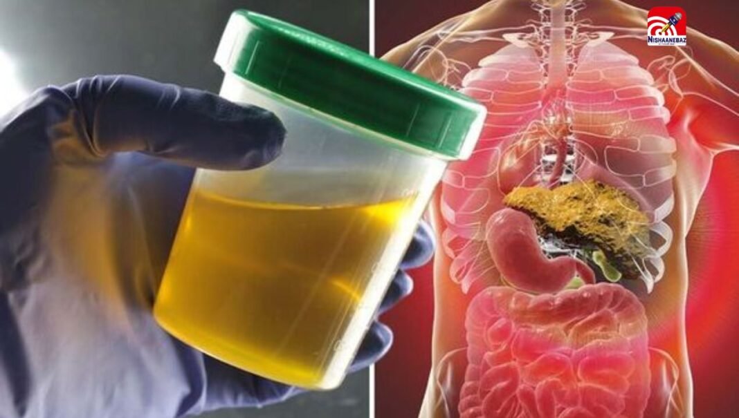 क्या ‘पीले पेशाब ‘का है लिवर खराब होने से संबंध! जानिए डॉक्टर की राय
