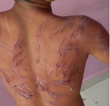 Raipur Crime : नशामुक्ति केंद्र में ‘टॉर्चर’: युवक को पाइप से पीटने का वीडियो वायरल, संचालिका के बेटे पर केस, परिजनों का सनसनीखेज आरोप