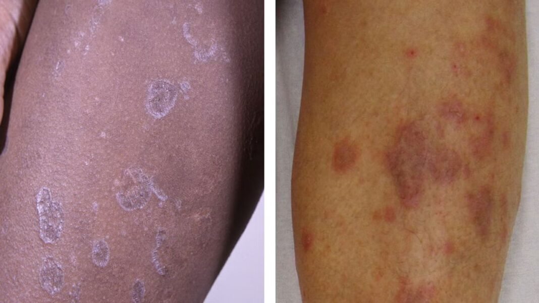 Skin Rashes Alert: स्किन पर बार-बार लाल चकत्ते दिखना सामान्य एलर्जी नहीं, हो सकता है ब्लड कैंसर का शुरुआती संकेत: डॉक्टर