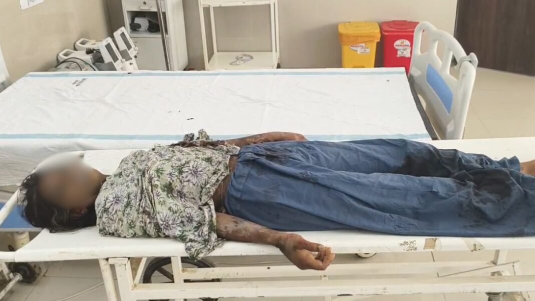 Barwani Acid Accident: खेत में सो रहे मासूम बच्चे और मां पर गिरा तेजाब, दो बच्चे गंभीर रूप से झुलसे