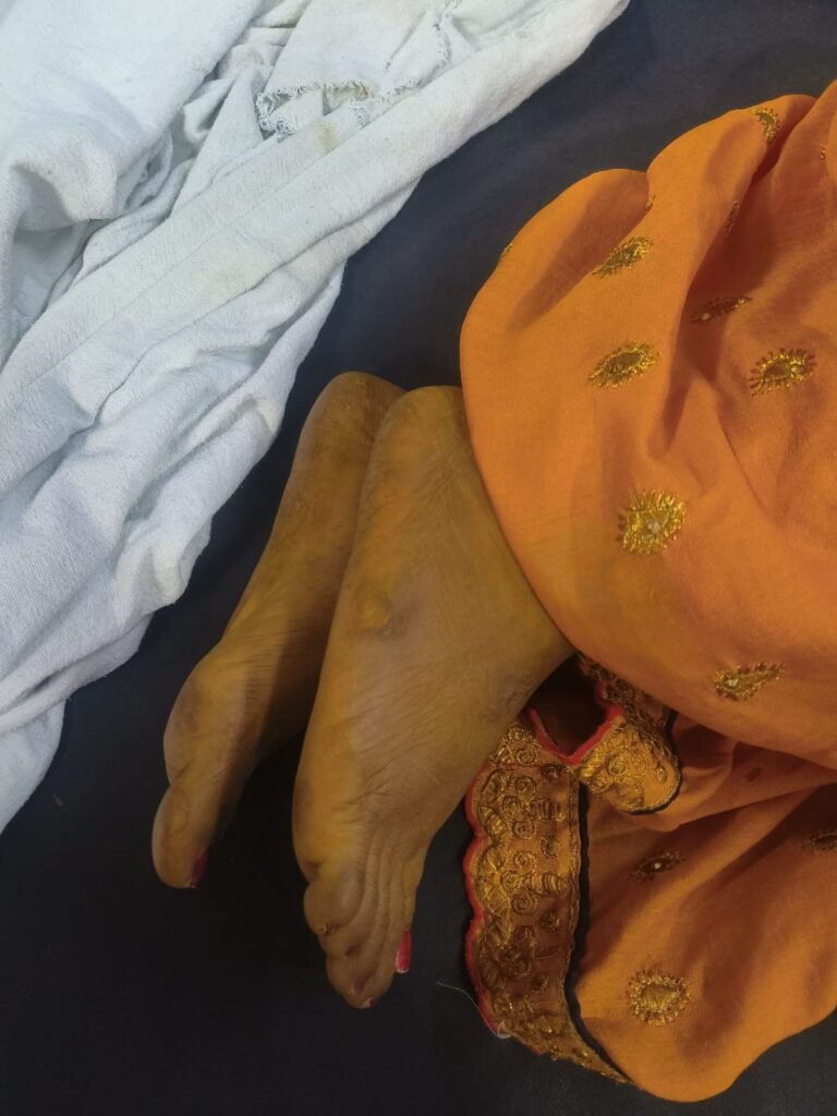 Indore Adulterated Turmeric News : इंदौर: मिलावटी हल्दी ने शादि में घोला जहर; रस्म के बाद वेंटिलेटर पर पहुंची दुल्हन, कई अन्य भी बीमार