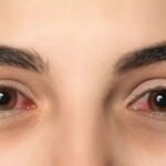 Monsoon Eye Infection: बारिश में क्यों तेजी से फैलता है आई फ्लू? जानें इसके मुख्य कारण और लक्षण