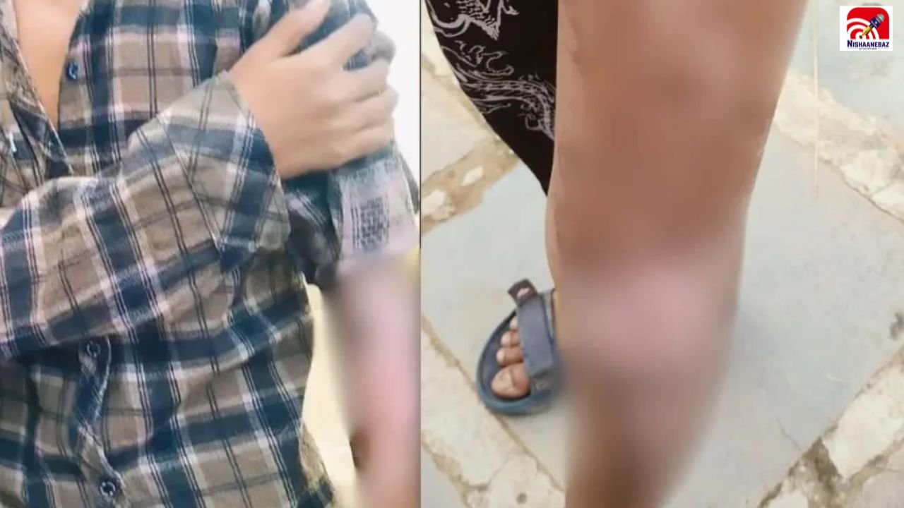 CG News: गरियाबंद छात्रावास में गर्म दाल से झुलसे 2 छात्र, परिजनों को सूचना नहीं देने का आरोप